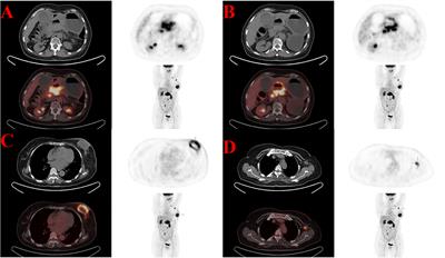 Next-generation sequencing-based detection in a breast  - Frontiers